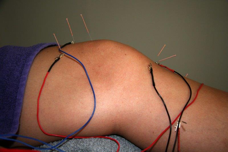 Electro Acupunctuur